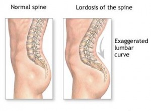 Excessive lordosis can lead to back pain