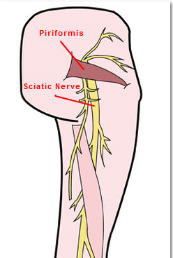 Sciatic Nerve Pain Relief Begs For Good Posture.