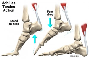 alignment of the achilles tendon