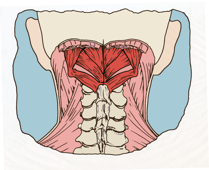 Muscle Tension Headache Back Of Head