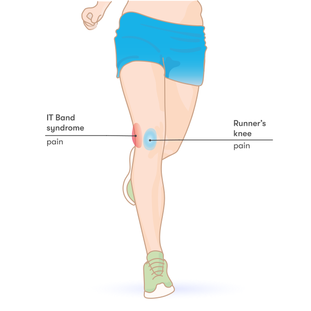 Running Injuries It Band And The Tfl