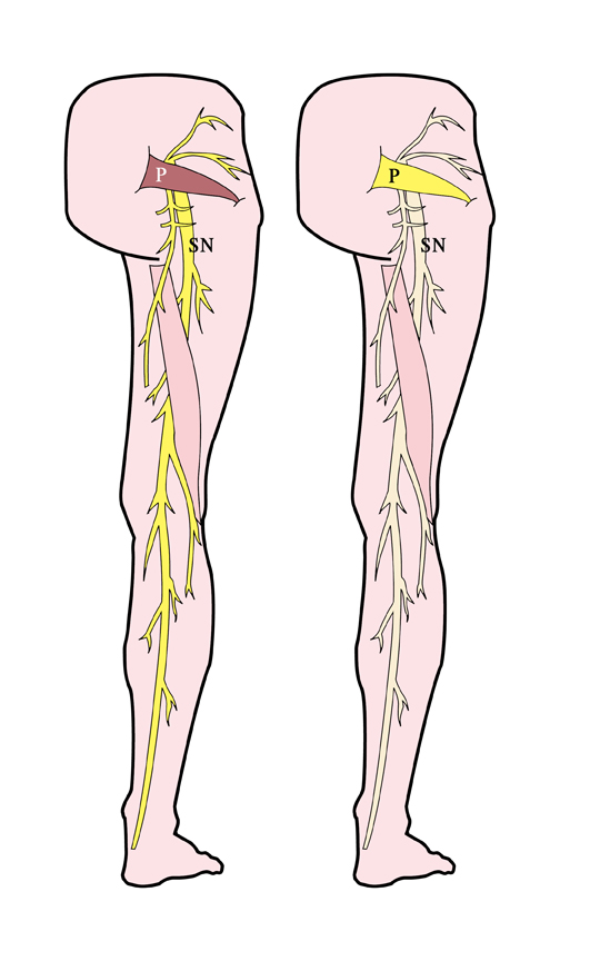 Why Do We Get Sciatica and Piriformis Syndrome