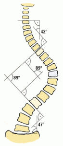 A short primer on scoliosis, a curvature of the spine.