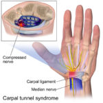 Carpal Tunnel Syndrome and the Median Nerve: A Primer