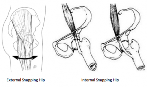 snapping hip syndrome