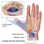 The Carpal Tunnel And The Wrist And Their Issues