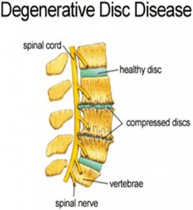 What is degenerative disc disease?