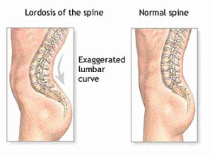 Poor Posture and Tight Lower Back Muscles