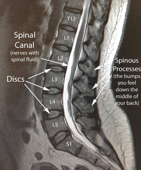 lumbar normal sag mri w text - CoreWalking