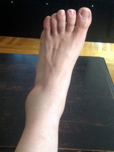 I sprained my ankle