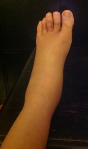 sprained ankle