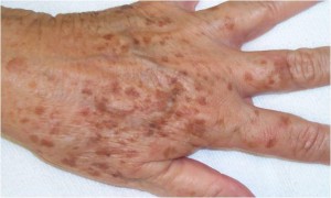 liver spots